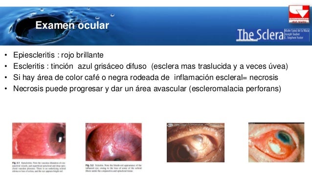 escleritis y epiescleritis